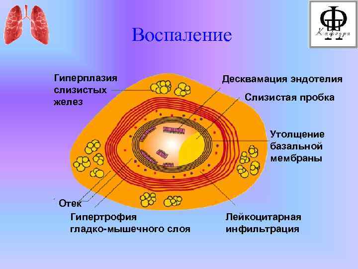 Воспаление Гиперплазия слизистых желез Десквамация эндотелия Слизистая пробка Утолщение базальной мембраны Отек Гипертрофия гладко-мышечного