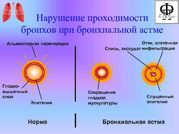 Рентгеновская картина нарушений бронхиальной проходимости