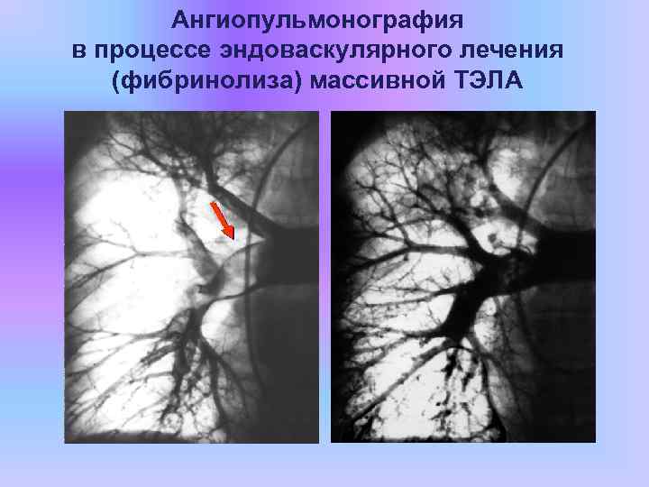 Ангиопульмонография в процессе эндоваскулярного лечения (фибринолиза) массивной ТЭЛА 