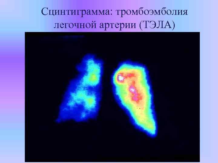 Сцинтиграмма: тромбоэмболия легочной артерии (ТЭЛА) 
