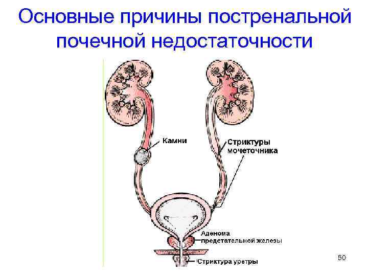 Основные причины постренальной почечной недостаточности 50 
