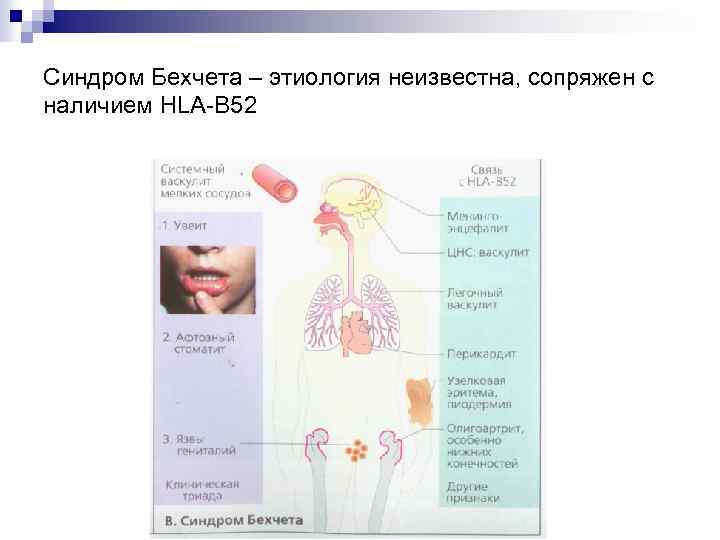 Синдром Бехчета – этиология неизвестна, сопряжен с наличием HLA-B 52 