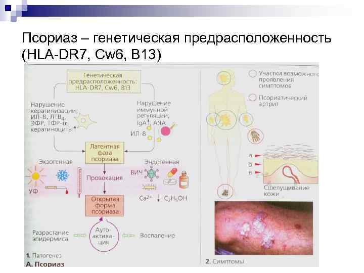 Псориаз – генетическая предрасположенность (HLA-DR 7, Cw 6, B 13) 