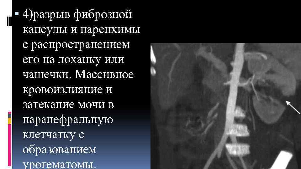  4)разрыв фиброзной капсулы и паренхимы с распространением его на лоханку или чашечки. Массивное