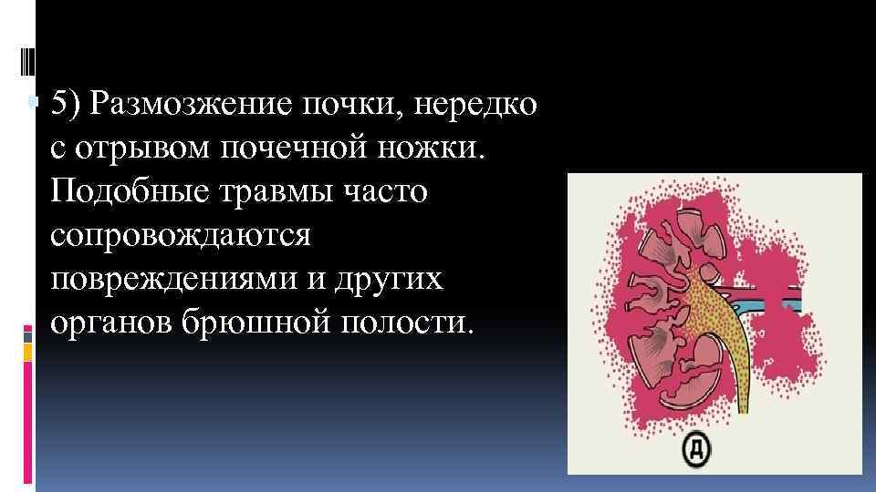  5) Размозжение почки, нередко с отрывом почечной ножки. Подобные травмы часто сопровождаются повреждениями