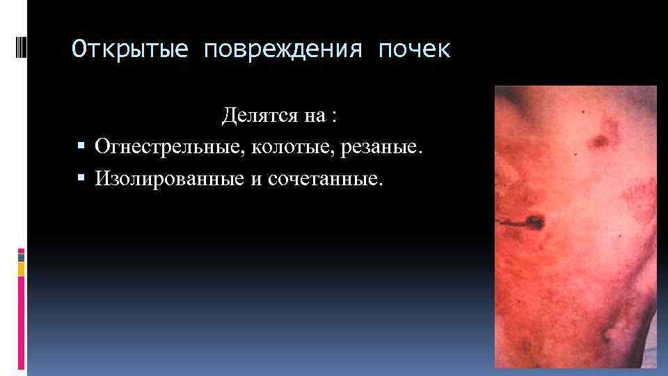 Открытые повреждения почек Делятся на : Огнестрельные, колотые, резаные. Изолированные и сочетанные. 