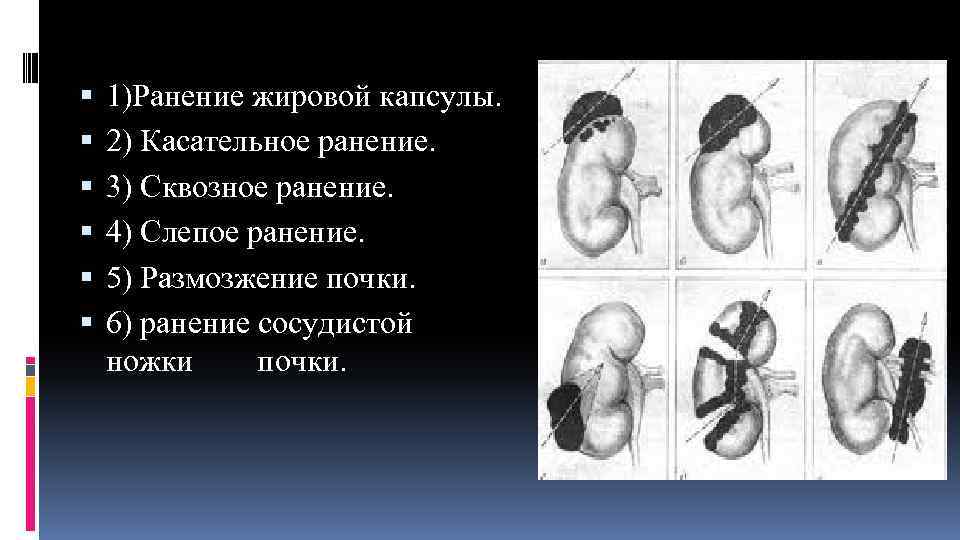  1)Ранение жировой капсулы. 2) Касательное ранение. 3) Сквозное ранение. 4) Слепое ранение. 5)