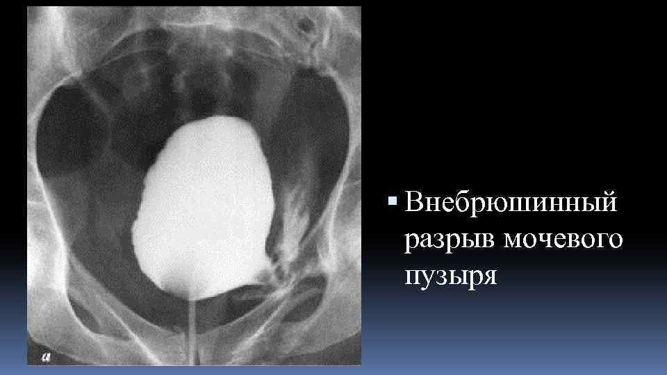  Внебрюшинный разрыв мочевого пузыря 