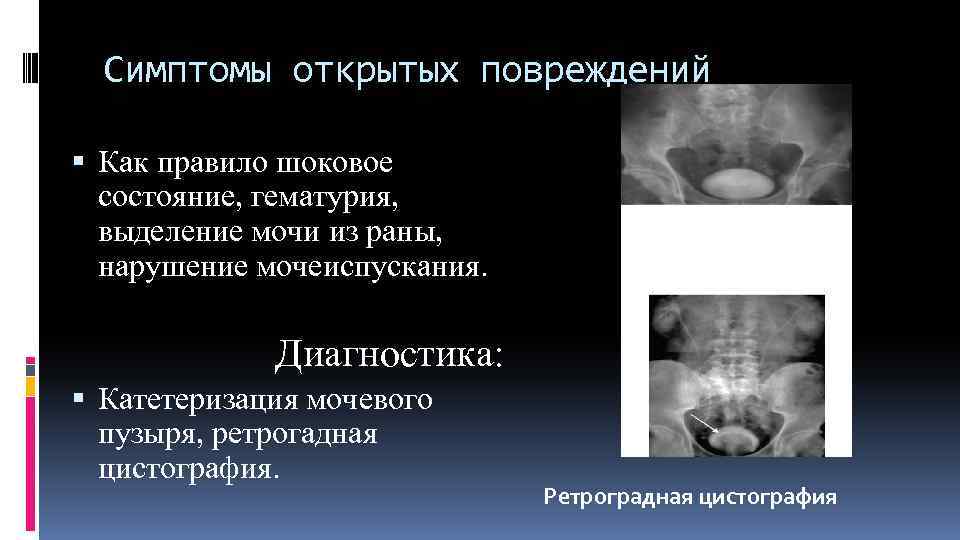 Симптомы открытых повреждений Как правило шоковое состояние, гематурия, выделение мочи из раны, нарушение мочеиспускания.