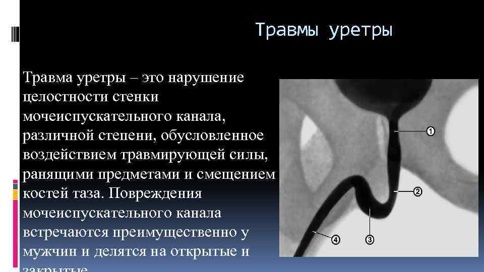 Травмы уретры Травма уретры – это нарушение целостности стенки мочеиспускательного канала, различной степени, обусловленное