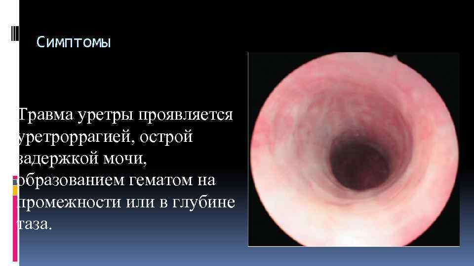 Симптомы Травма уретры проявляется уретроррагией, острой задержкой мочи, образованием гематом на промежности или в