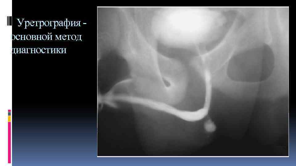 Уретрография основной метод диагностики 