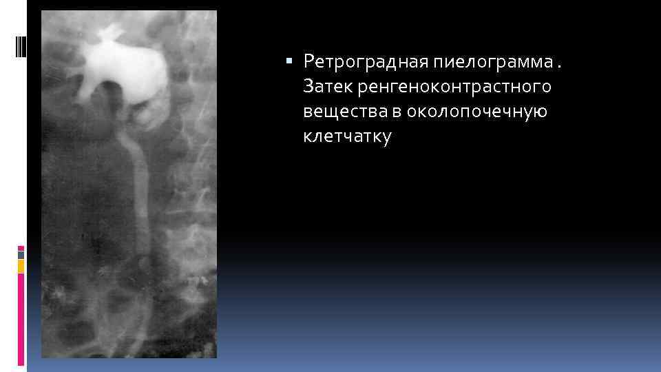  Ретроградная пиелограмма. Затек ренгеноконтрастного вещества в околопочечную клетчатку 