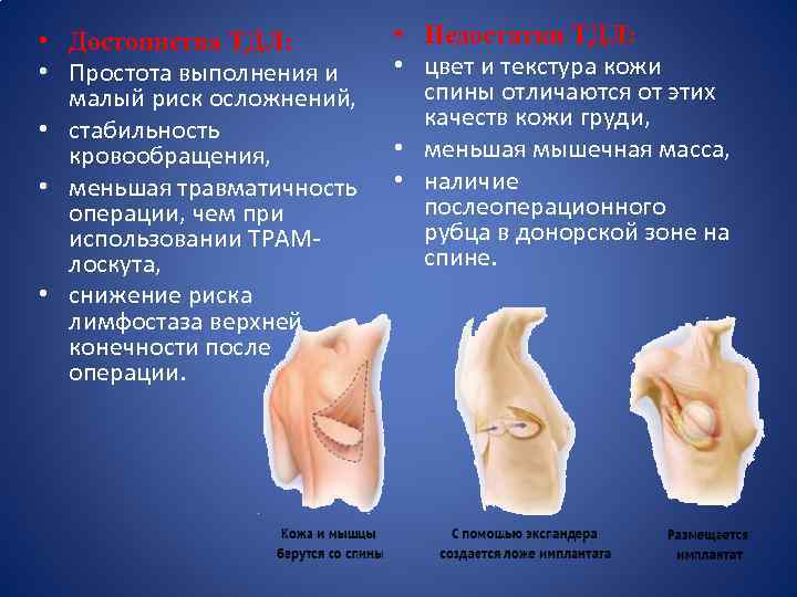  • Достоинства ТДЛ: • Простота выполнения и малый риск осложнений, • стабильность кровообращения,