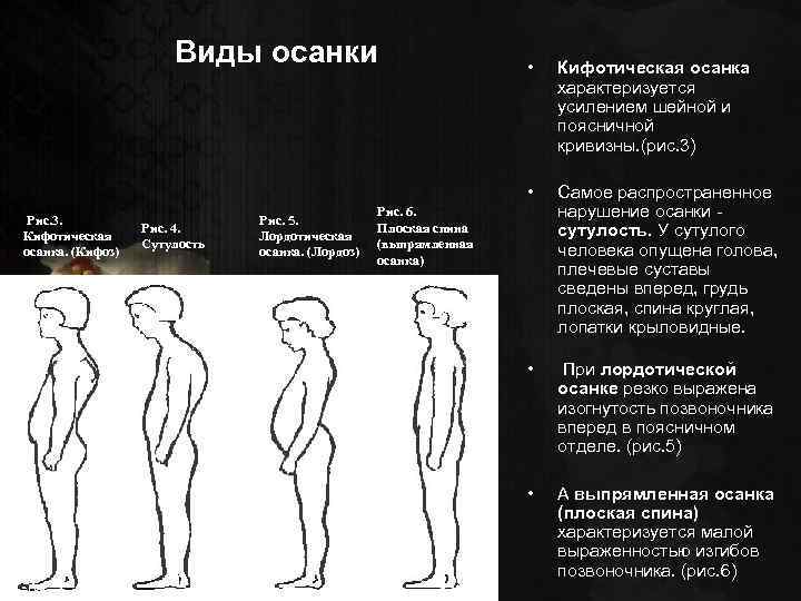 Как называется нарушение осанки изображенное на рисунке