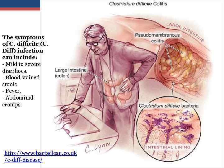 The symptoms of C. difficile (C. Diff) infection can include: - Mild to severe