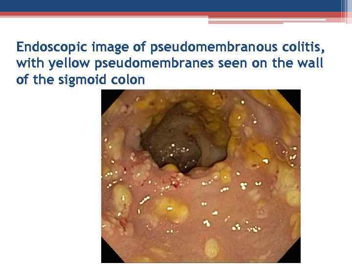 Endoscopic image of pseudomembranous colitis, with yellow pseudomembranes seen on the wall of the