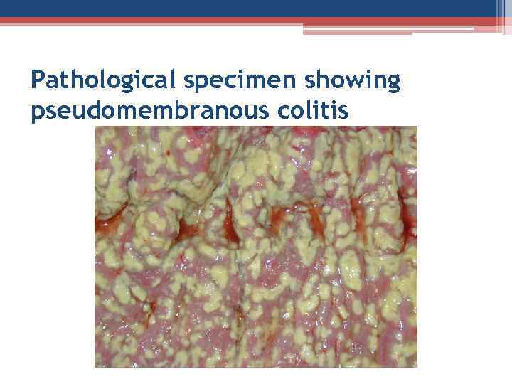 Pathological specimen showing pseudomembranous colitis 
