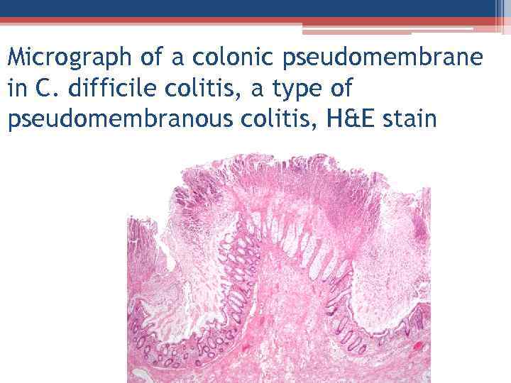 Micrograph of a colonic pseudomembrane in C. difficile colitis, a type of pseudomembranous colitis,