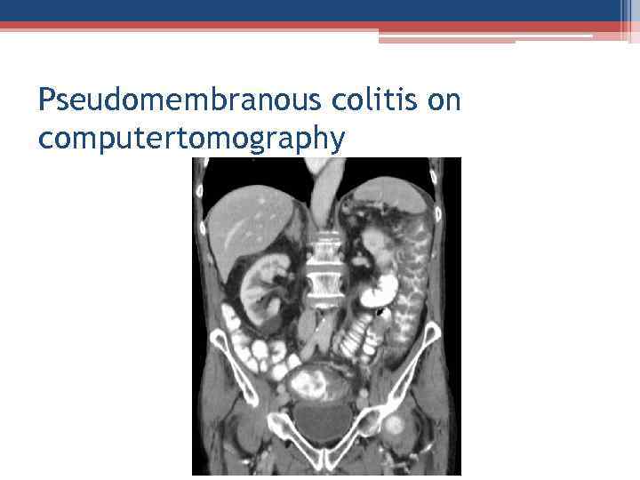 Pseudomembranous colitis on computertomography 