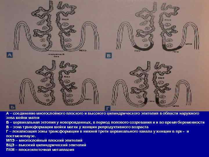 А – соединение многослойного плоского и высокого цилиндрического эпителия в области наружного зева шейки