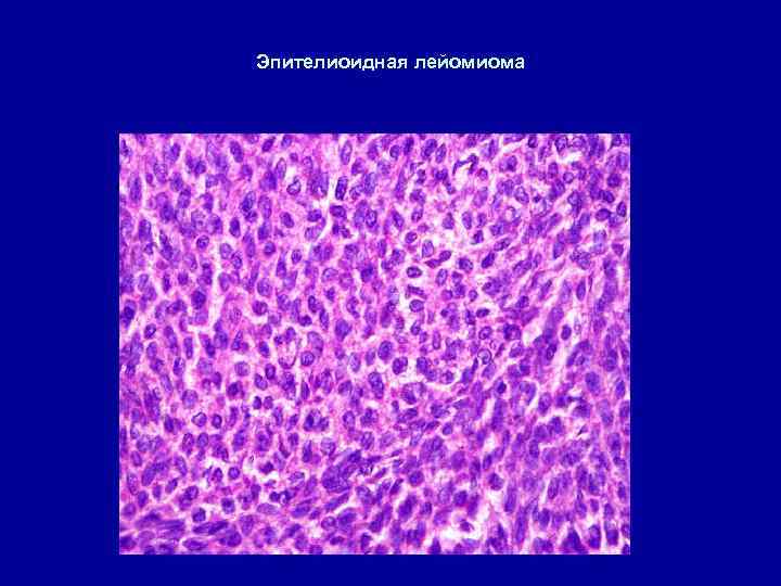 Эпителиоидная лейомиома 
