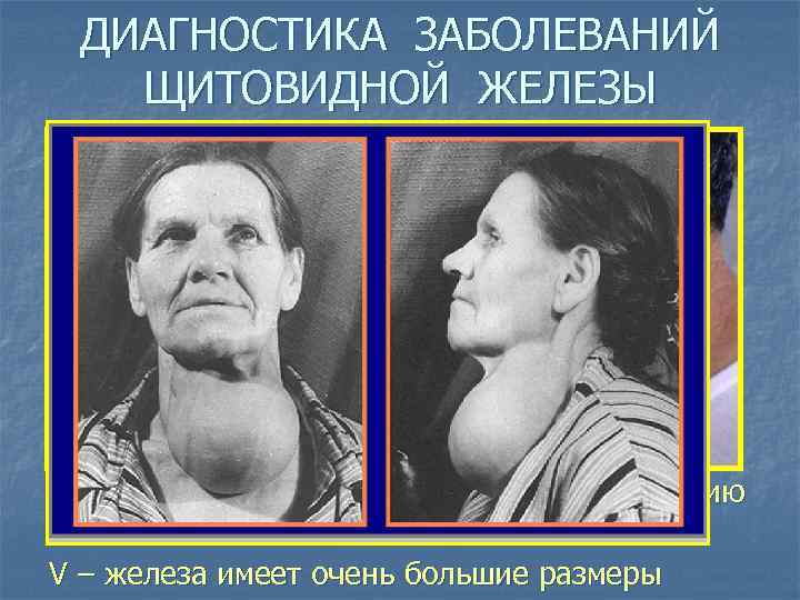 ДИАГНОСТИКА ЗАБОЛЕВАНИЙ ЩИТОВИДНОЙ ЖЕЛЕЗЫ ОСМОТР Степени увеличения щитовидной железы: 0 – железа не заметна