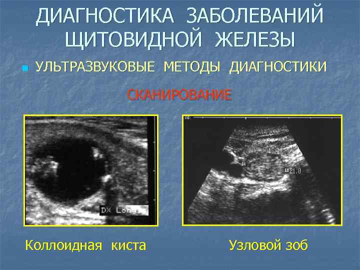 ДИАГНОСТИКА ЗАБОЛЕВАНИЙ ЩИТОВИДНОЙ ЖЕЛЕЗЫ n УЛЬТРАЗВУКОВЫЕ МЕТОДЫ ДИАГНОСТИКИ СКАНИРОВАНИЕ Коллоидная киста Узловой зоб 