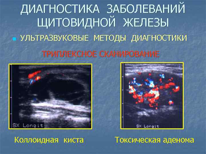 ДИАГНОСТИКА ЗАБОЛЕВАНИЙ ЩИТОВИДНОЙ ЖЕЛЕЗЫ n УЛЬТРАЗВУКОВЫЕ МЕТОДЫ ДИАГНОСТИКИ ТРИПЛЕКСНОЕ СКАНИРОВАНИЕ Коллоидная киста Токсическая аденома