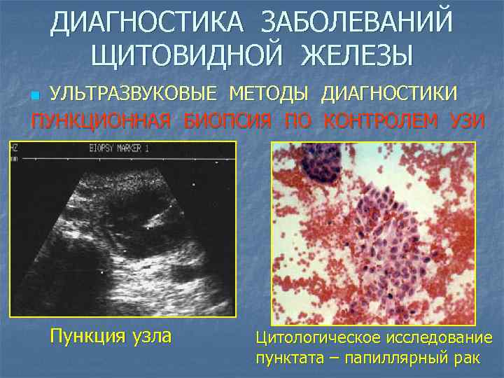 ДИАГНОСТИКА ЗАБОЛЕВАНИЙ ЩИТОВИДНОЙ ЖЕЛЕЗЫ УЛЬТРАЗВУКОВЫЕ МЕТОДЫ ДИАГНОСТИКИ ПУНКЦИОННАЯ БИОПСИЯ ПО КОНТРОЛЕМ УЗИ n Пункция