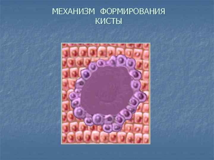 МЕХАНИЗМ ФОРМИРОВАНИЯ КИСТЫ 