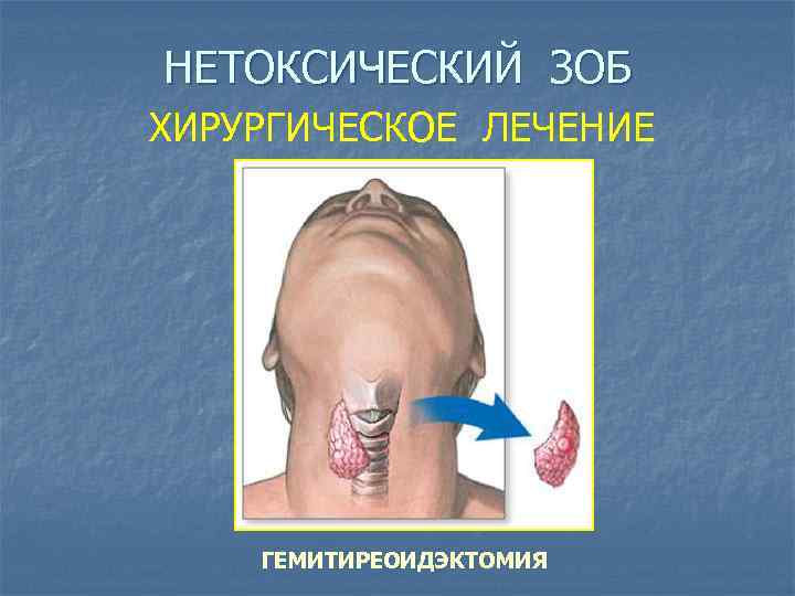 НЕТОКСИЧЕСКИЙ ЗОБ ХИРУРГИЧЕСКОЕ ЛЕЧЕНИЕ ГЕМИТИРЕОИДЭКТОМИЯ 