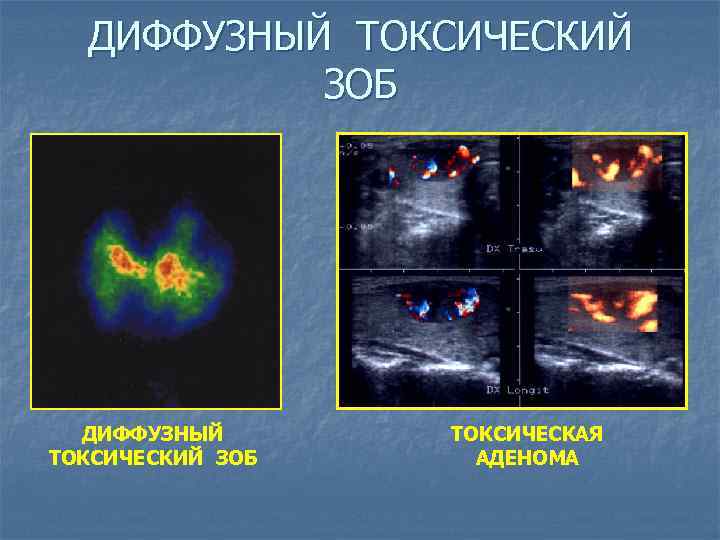 ДИФФУЗНЫЙ ТОКСИЧЕСКИЙ ЗОБ ТОКСИЧЕСКАЯ АДЕНОМА 