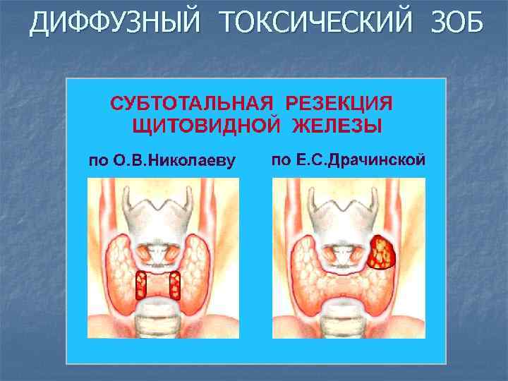 ДИФФУЗНЫЙ ТОКСИЧЕСКИЙ ЗОБ 