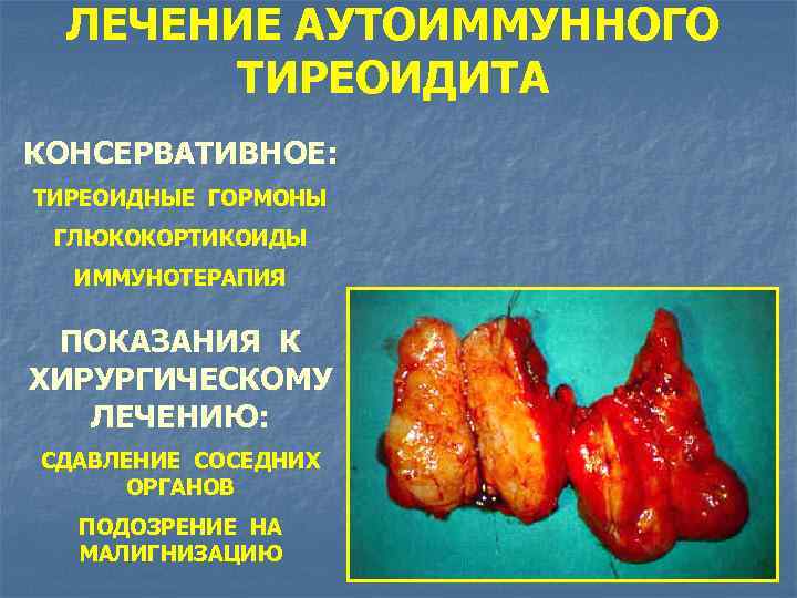 ЛЕЧЕНИЕ АУТОИММУННОГО ТИРЕОИДИТА КОНСЕРВАТИВНОЕ: ТИРЕОИДНЫЕ ГОРМОНЫ ГЛЮКОКОРТИКОИДЫ ИММУНОТЕРАПИЯ ПОКАЗАНИЯ К ХИРУРГИЧЕСКОМУ ЛЕЧЕНИЮ: СДАВЛЕНИЕ СОСЕДНИХ