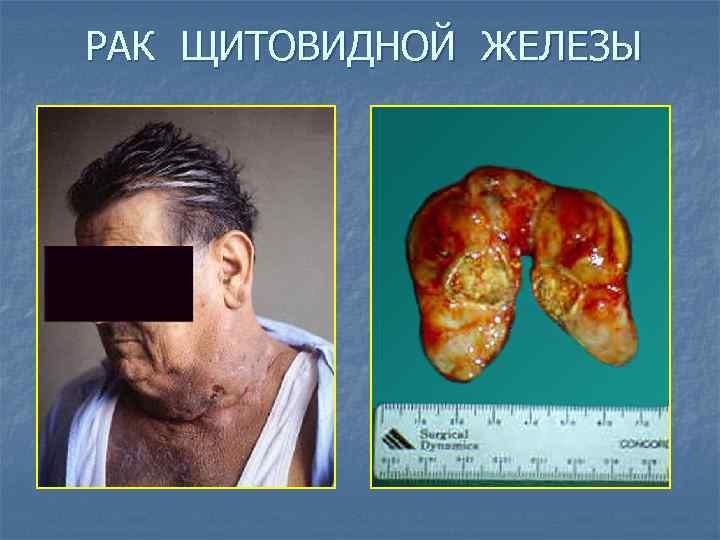 РАК ЩИТОВИДНОЙ ЖЕЛЕЗЫ 