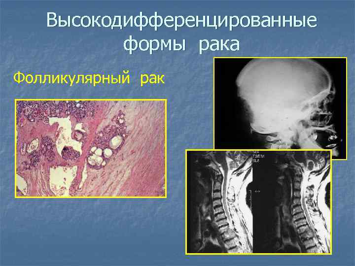 Высокодифференцированные формы рака Фолликулярный рак 