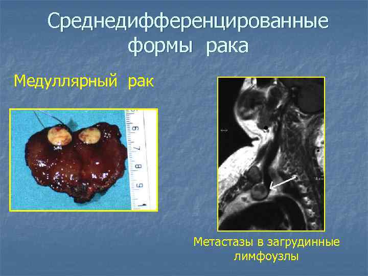 Среднедифференцированные формы рака Медуллярный рак Метастазы в загрудинные лимфоузлы 