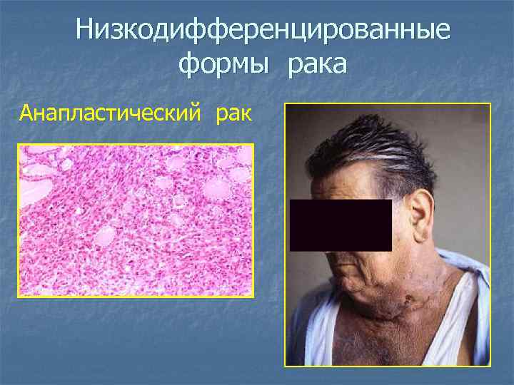 Низкодифференцированные формы рака Анапластический рак 