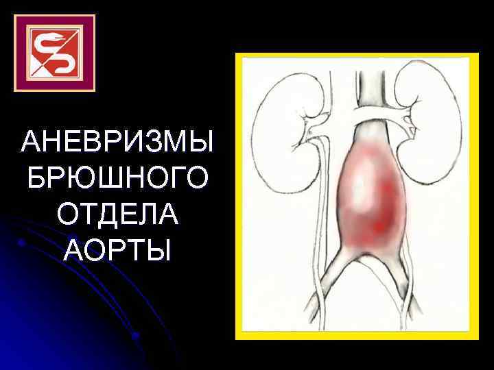 АНЕВРИЗМЫ БРЮШНОГО ОТДЕЛА АОРТЫ 