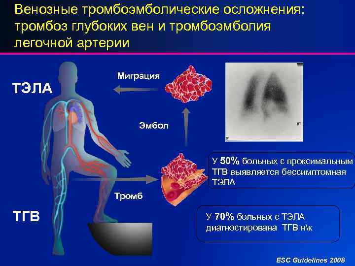 Венозные тромбоэмболические осложнения: тромбоз глубоких вен и тромбоэмболия легочной артерии ТЭЛА Миграция Эмбол У