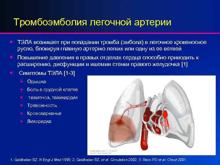 Тромбоэмболия легочной артерии ® ТЭЛА возникает при попадании тромба (эмбола) в легочное кровеносное русло,