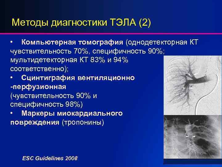 Методы диагностики ТЭЛА (2) • Компьютерная томография (однодетекторная КТ чувствительность 70%, специфичность 90%; мультидетекторная