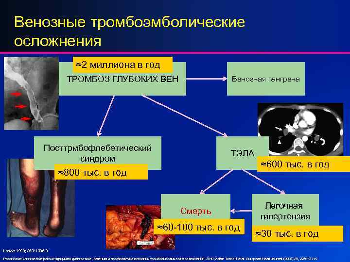 Венозные тромбоэмболические осложнения ≈2 миллиона в год ТРОМБОЗ ГЛУБОКИХ ВЕН Венозная гангрена Посттрмбофлебетический синдром