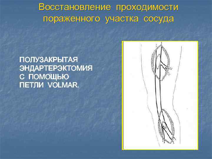 Восстановление проходимости пораженного участка сосуда ПОЛУЗАКРЫТАЯ ЭНДАРТЕРЭКТОМИЯ С ПОМОЩЬЮ ПЕТЛИ VOLMAR. 