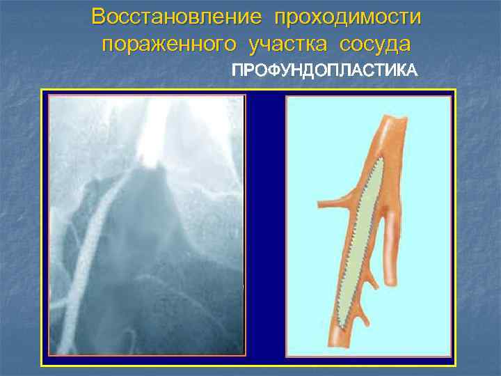 Восстановление проходимости пораженного участка сосуда ПРОФУНДОПЛАСТИКА 