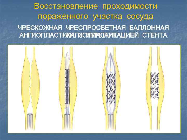 Облитерирующий эндартериит презентация