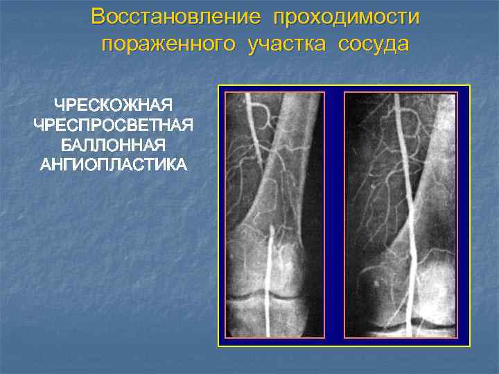 Восстановление проходимости пораженного участка сосуда ЧРЕСКОЖНАЯ ЧРЕСПРОСВЕТНАЯ БАЛЛОННАЯ АНГИОПЛАСТИКА 