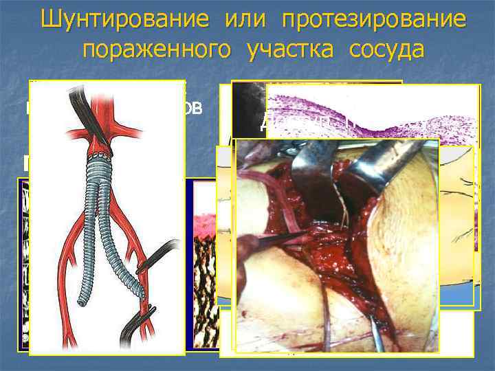Шунтирование или протезирование пораженного участка сосуда СИНТЕТИЧЕСКИЕ ПРОТЕЗЫ СОСУДОВ Доступ по Робу ПТФЭ ТКАНЫЕ