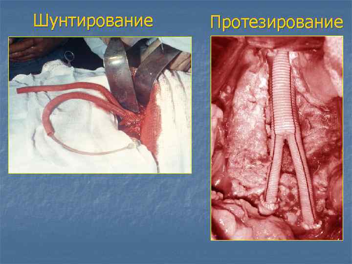 Шунтирование Протезирование 
